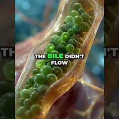 Yellow Poop? Is Your Liver On Strike? Find Out! #shorts