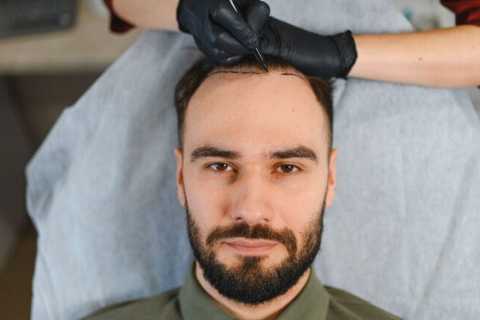 Top 10 Best Hair Transplant in Turkey